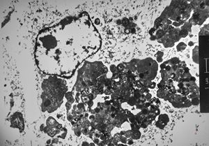 F,54y. | giant complex melanosomes … melanotic carcinosarcoma - uterus F,54y. | giant complex melanosomes … melanotic carcinosarcoma - uterus